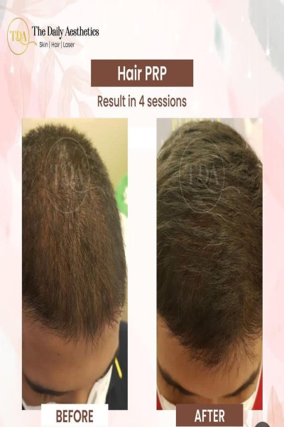 Hair Transplant