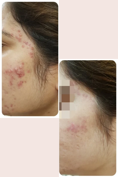 Skin Allergy Treatment Kharadi