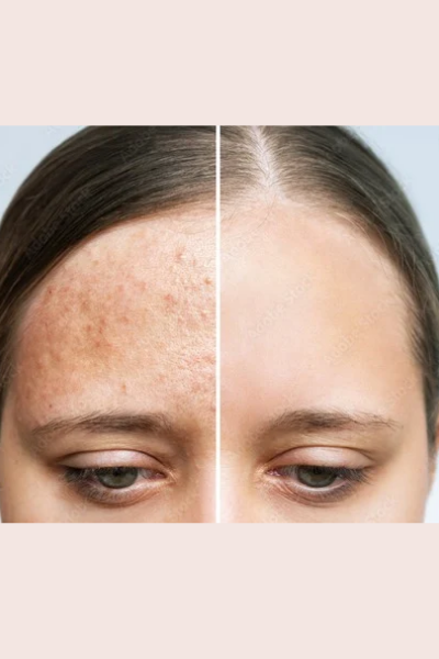 Skin Allergy