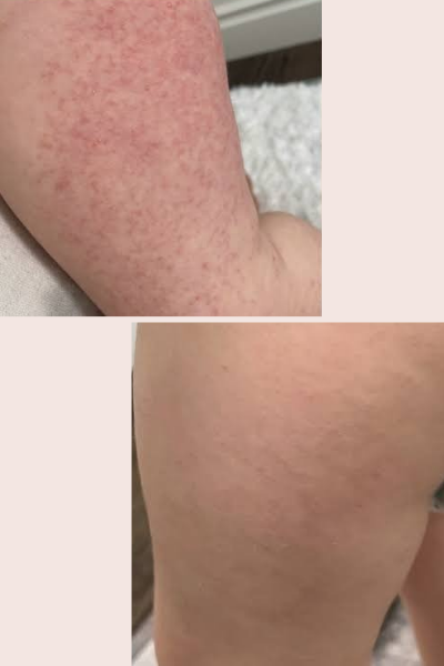 Skin Allergy