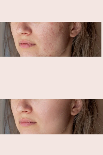 Skin Allergy