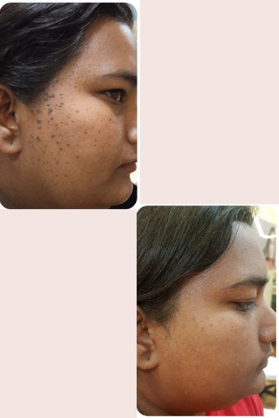 Skin Laser Treatment Kharadi