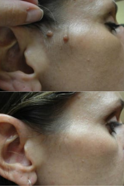 Skin Tag Removal Kharadi