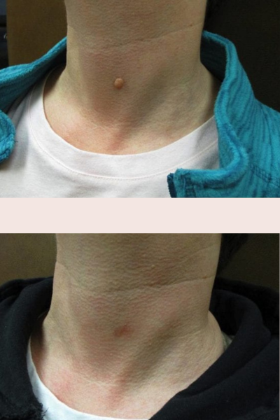 Skin Tag Removal Treatment Pune
