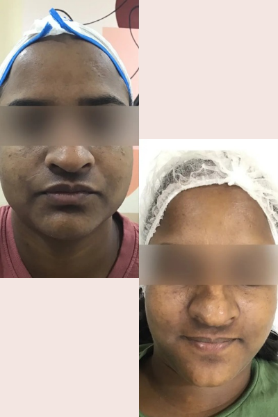 Skin Tan Removal