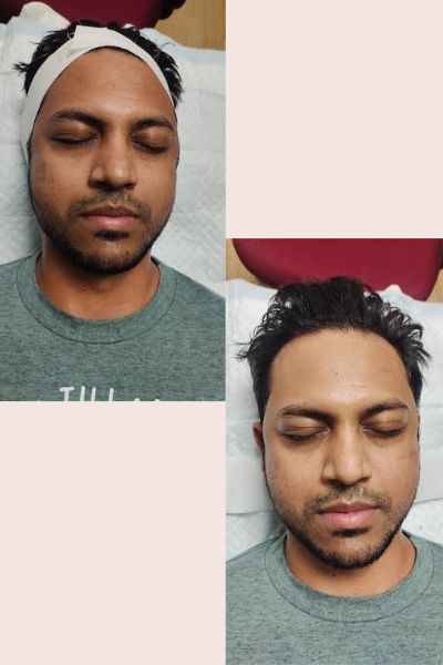Skin Tan Removal