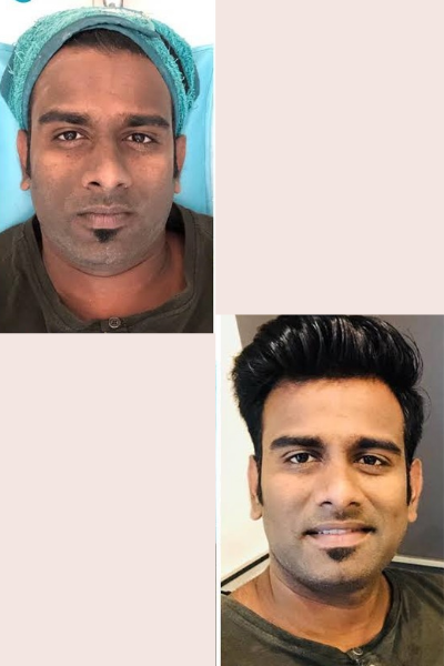 Skin Tan Removal
