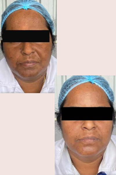Skin Tan Removal