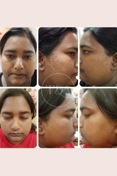 Skin Laser Treatment