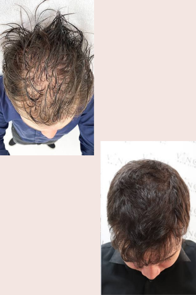 a man with his hair loss