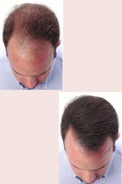Hair Meso Therapy