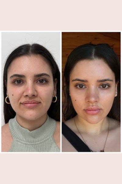 Celebrity Vampire Facial
