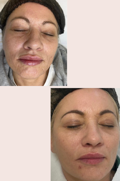 Celebrity Vampire Facial