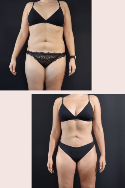 Body Contouring