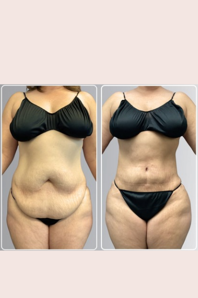 Figure Correction Treatment