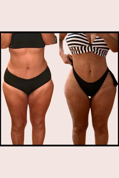 Figure Correction Treatment