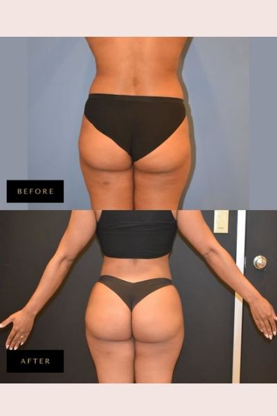 Figure Correction Treatment