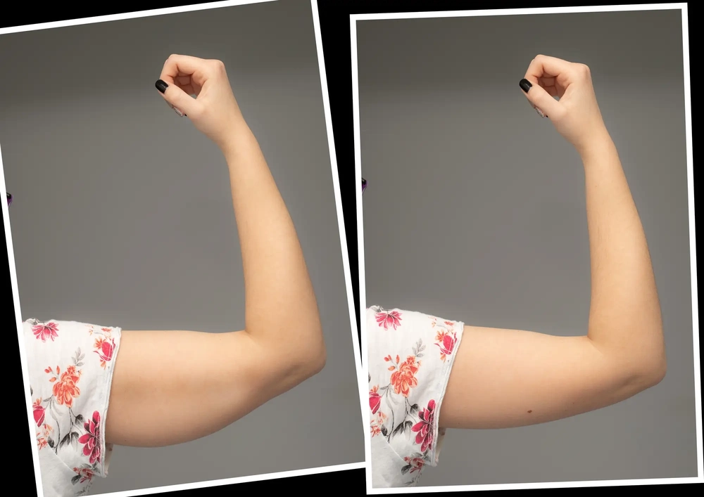 Arm Contouring