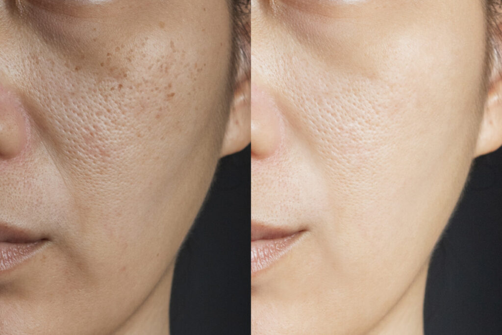 Chemical Peel