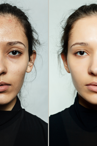 Skin Whitening
