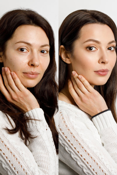 Skin Whitening