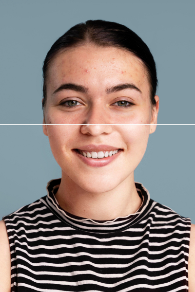 Skin Whitening
