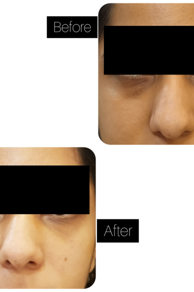 Skin Whitening