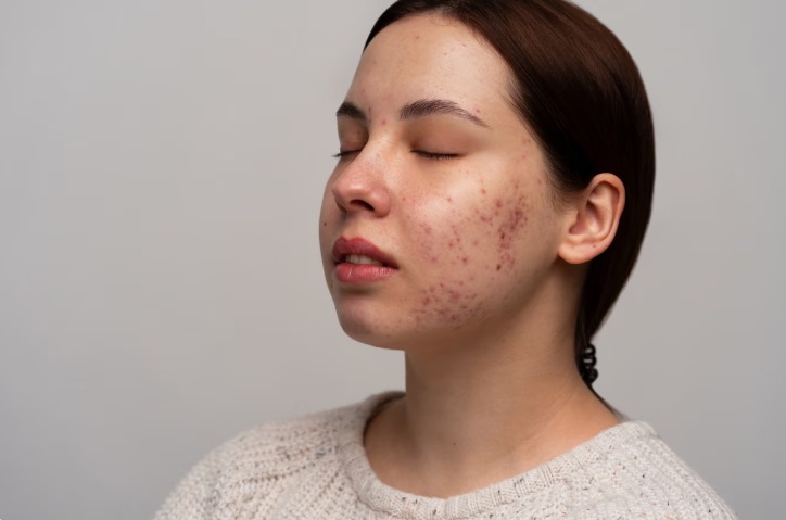 Skin Laser Treatment
