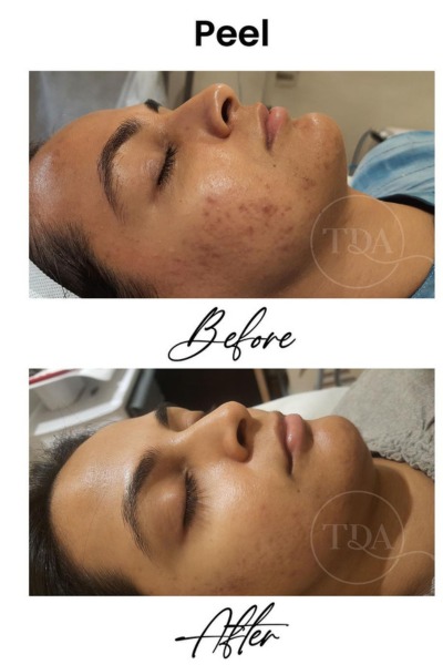 Derma/Chemical Peel