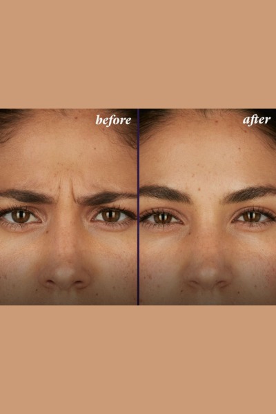 Botox