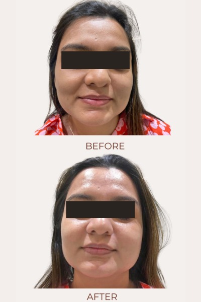 Hydrafacial