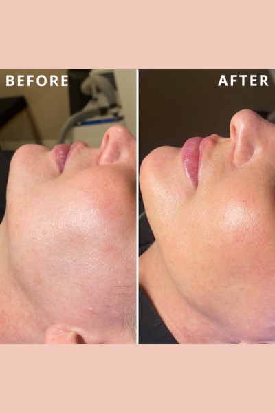 Hydrafacial