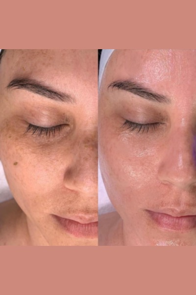 Hydrafacial
