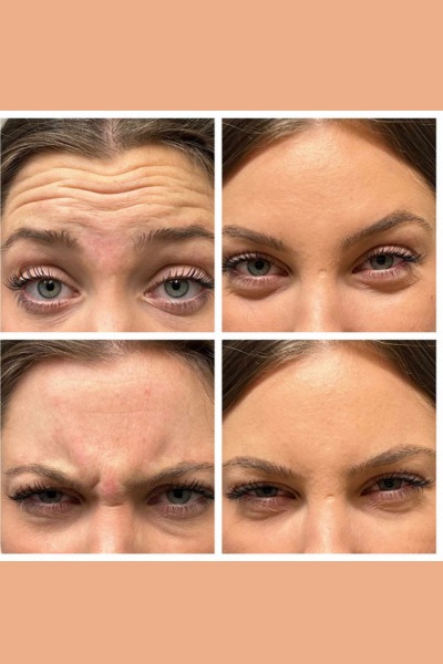 Anti Wrinkle