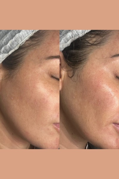 Hydrafacial