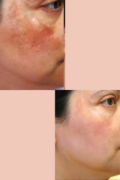 Pigmentation