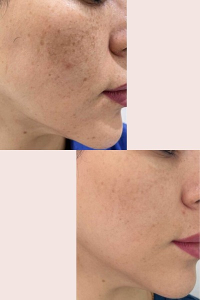 Pigmentation