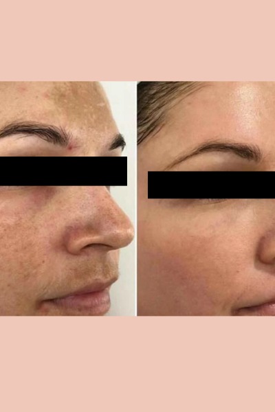 Pigmentation