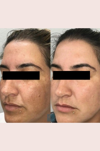 Pigmentation