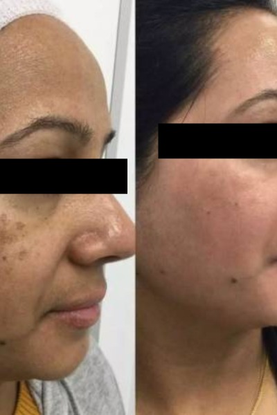 Pigmentation