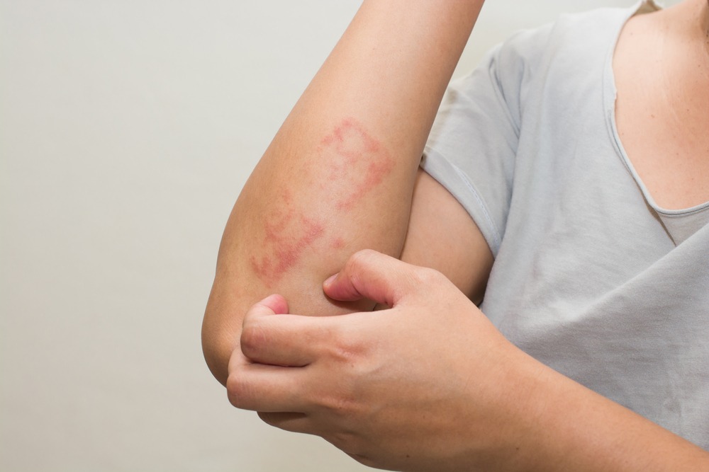 Skin Allergy
