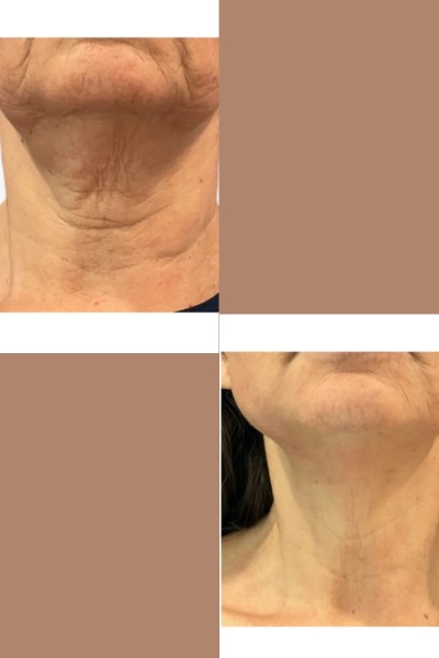 Thred Lift Treatment