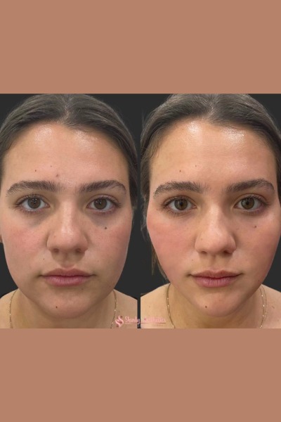 Thread Lift Treatment
