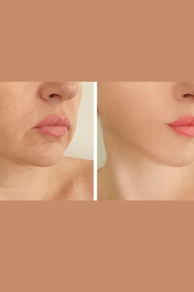 Thread lift treatment