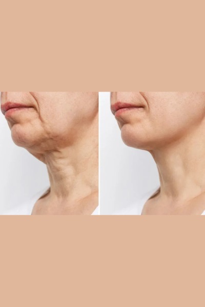 Thread Lift Treatment