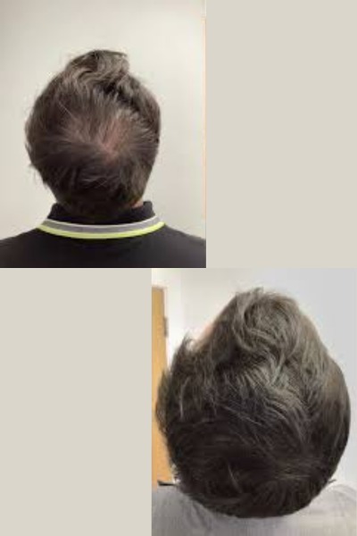 PRP air Loss Treatment