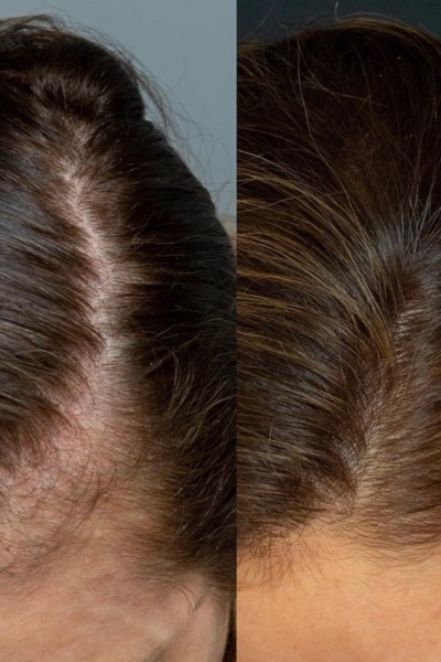 PRP Hair Loss Treatment