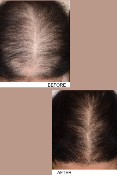 PRP Hair Treatment