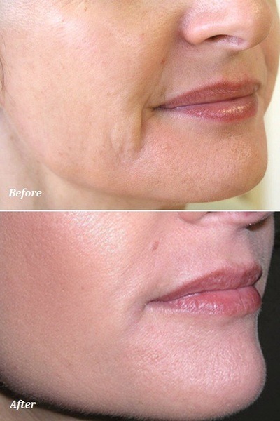Dermal Filler