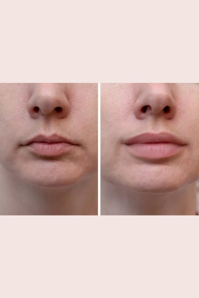Dermal Fillers